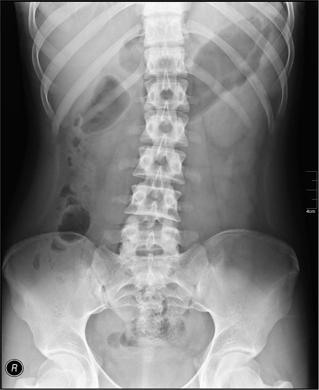 اشعة سينية X-ray للبطن